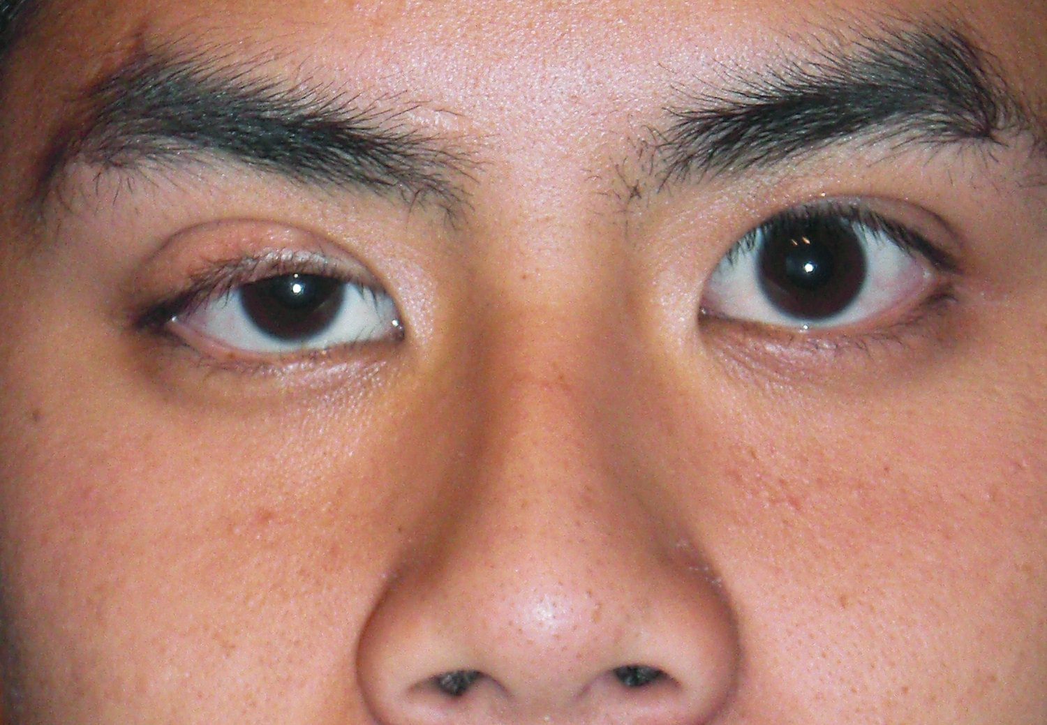 Belgoptic - Blog Hangende oogleden: van natuurlijke oefeningen tot ooglidcorrectie